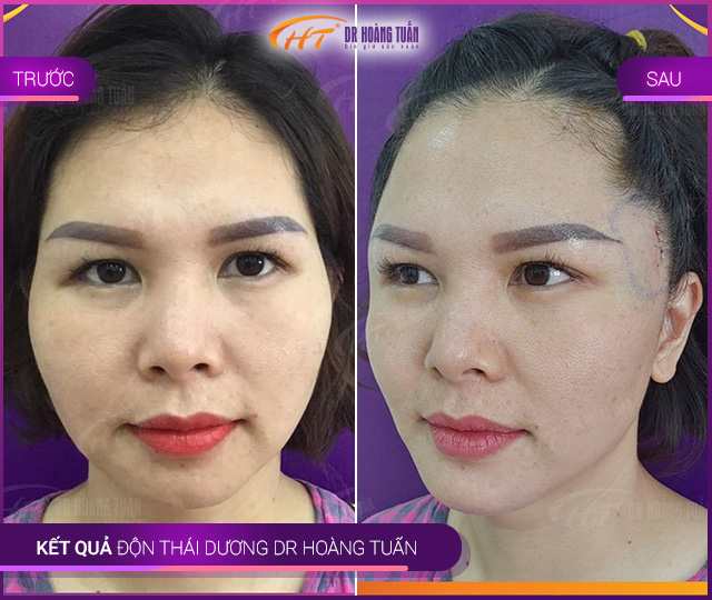 Kết quả độn thái dương tại Thẩm mỹ Hoàng Tuấn